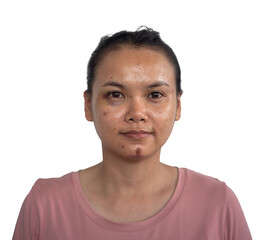 Obraz premium Woman face bruised due to surgery.