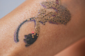 Young woman undergoing laser tattoo removal procedure in salon, closeup.