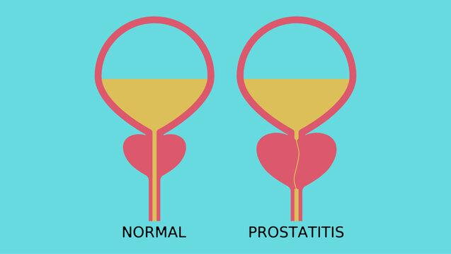 healthy prostate and prostatitis
