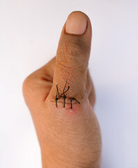 Stitches on a thumb. Stitches used to stitch up skin of a thumb on isolated white background. Selective focus.