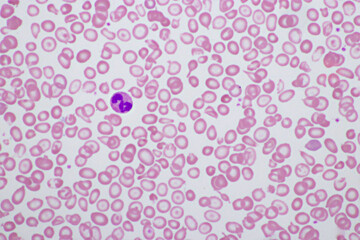 Abnormal red blood cells from thalassemia patient
