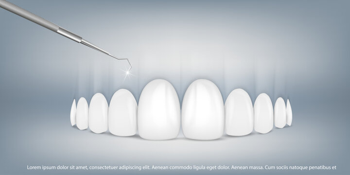 3d vector illustration, realistic teeth with braces upper and lower jaw. Alignment of the bite of teeth, dentition with braces, dental braces.
