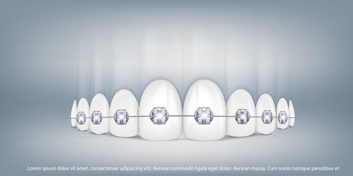 3d Vector Illustration, Realistic Teeth With Braces Upper And Lower Jaw. Alignment Of The Bite Of Teeth, Dentition With Braces, Dental Braces.