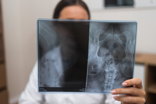 Radiographic close up: doctor radiologist holding X-ray film evaluating the results. 