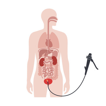 Cystoscopy examination concept