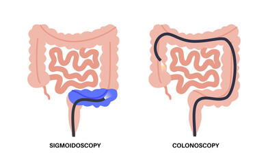 Colonoscopy and sigmoidoscopy - obrazy, fototapety, plakaty