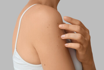 Young woman with moles on light background, closeup