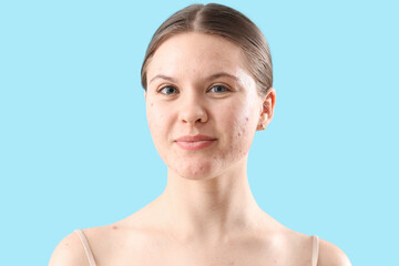 Teenage girl with acne problem on blue background, closeup