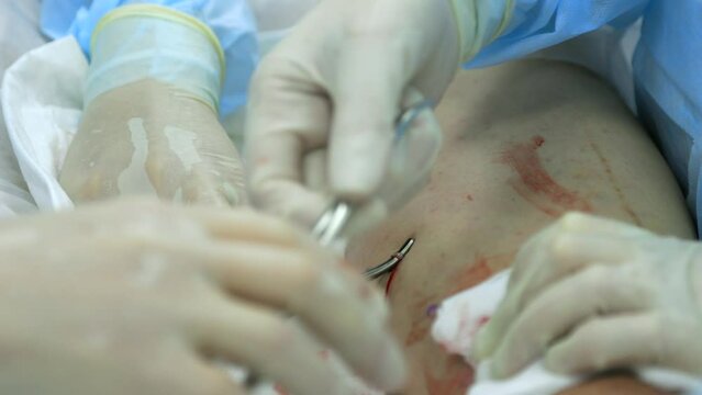 For surgery to remove varicose veins, the surgeon uses medical clamps, removes the varicose node. Process of removing the diseased vein from the puncture on the patient's leg during surgery