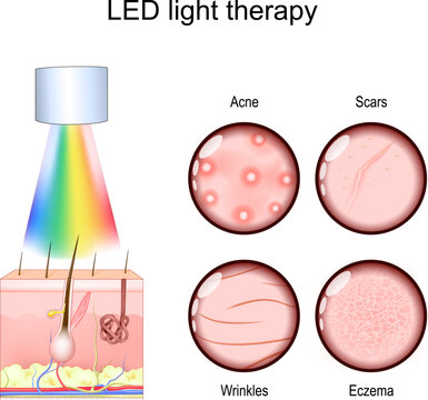 LED light therapy for Acne treatment, Scars, and Wrinkles reduction, and Eczema management.