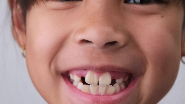 Close-up of cute young girl smiling wide, showing empty space with growing first front teeth. Little girl with big smile and missing milk teeth. Dental hygiene concept