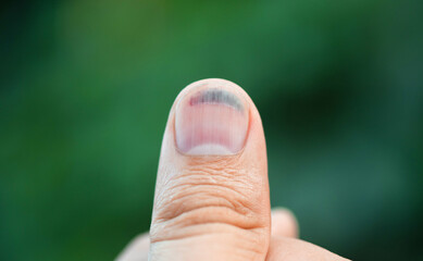 Large hematoma under the nail. Damage to the nail plate of a finger.