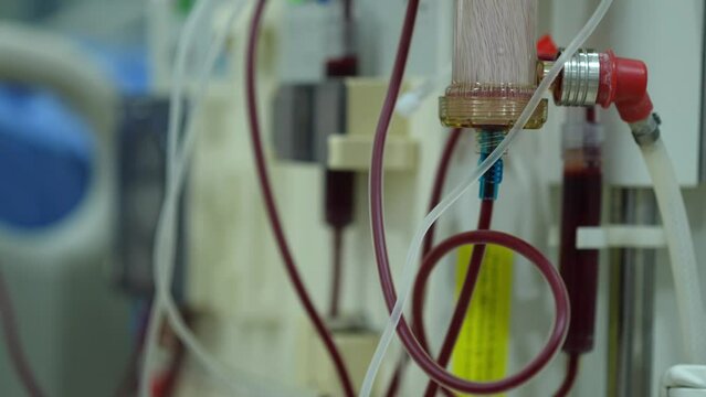 Dialysis machine is working. Acting as a substitute for the kidneys to drive waste from the body.
