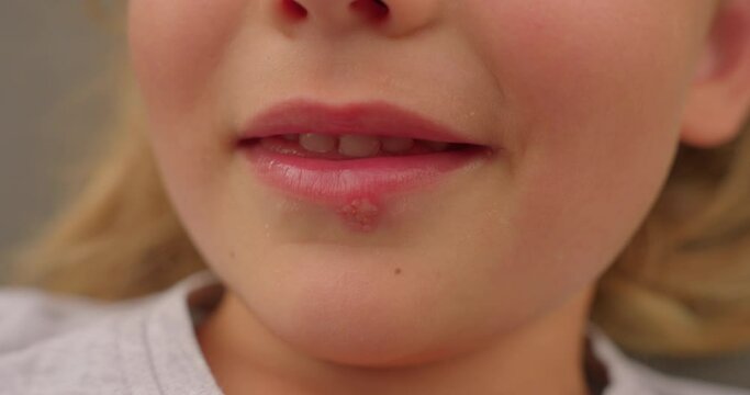 Little beautiful girl smiling with herpes virus disease on her lips. Close up