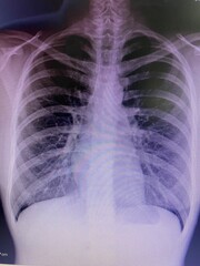 This picture is show normal film x-ray for medical and technology concept 
