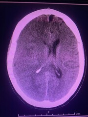 Ct scan show chronic subdural hemorrhage along right frontoparietooccipital region for medical and technology concept 