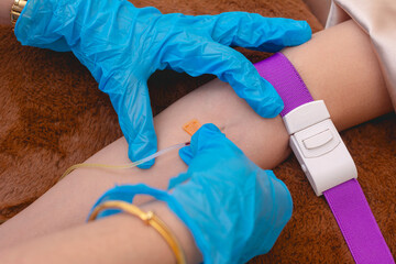 Inserting an intravenous needle and cannula into a patients arm. Glutathione IV infusion therapy...