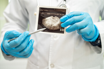 Uterus and ovary, doctor holding anatomy model and ultrasound picture for study diagnosis and treatment in hospital.