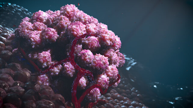 Small tumor cancer cells treatment cluster on the health tissue blood vessels side view oncology