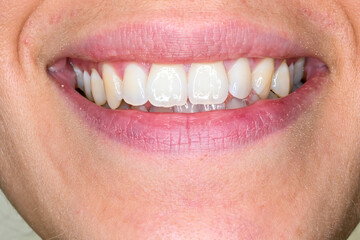Orthodontist's work on a mouth close-up