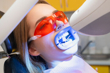 UV lamp shines on the patiens teeth during teeth whitening at dentist clinic.
