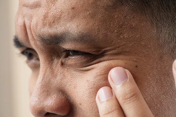 Photo of the rejuvenation of wrinkles around the eyes, crow's feet.