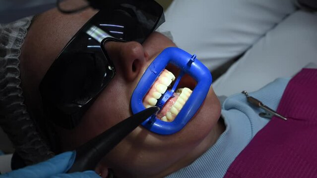 Dental Whitening process in patient mouth. Teeth whitening with UF Lamp, Led Lamp and gel. Dental Extreme Close up Macro Video. Concept of professional dental hygiene. 4k 120 fps slow motion footage