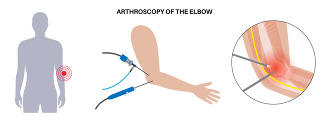 Elbow arthroscopy surgery