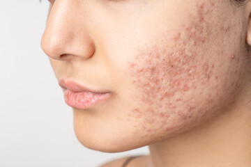 Acne on the young girl's face. Acne in teenage girl