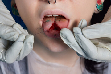 tongue splitting. cutting the tongue, one type of modification of the human body. surgery concept.