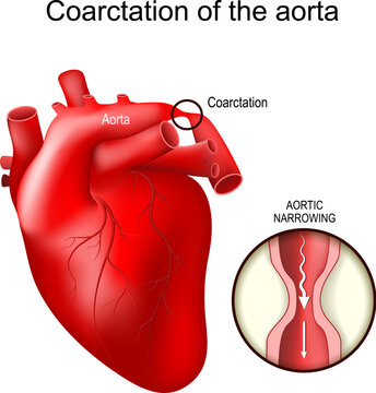 Aortic coarctations. Congenital heart defect.