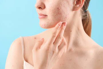 Teenage girl with acne problem on blue background, closeup