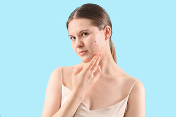 Teenage girl with acne problem on blue background, closeup