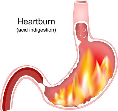 Heartburn. Cross section of a stomach with flame