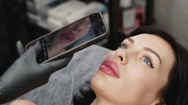 Medical office, a female doctor photographs the patient’s lips on the phone, after injections of hyaluronic acid into the lips, correction of the shape of the lips.