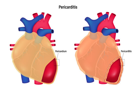 Pericarditis vector. Comparison between pericardium and pericarditis. Human heart anatomy.