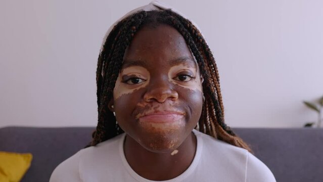 POV or portrait screen view of young woman with vitiligo listening on laptop computer video call sitting on sofa at home. Screen webcam view.