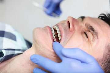 Cropped image of person on dental check. Middle - aged man with braces at an orthodontist 's appointment .Dental clinic, dental treatment.