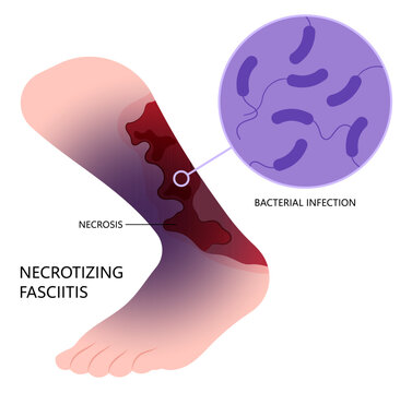 Bacteria infection on the skin cancer with Necrotizing fasciitis of leg cause limb pain fat scab in medical care