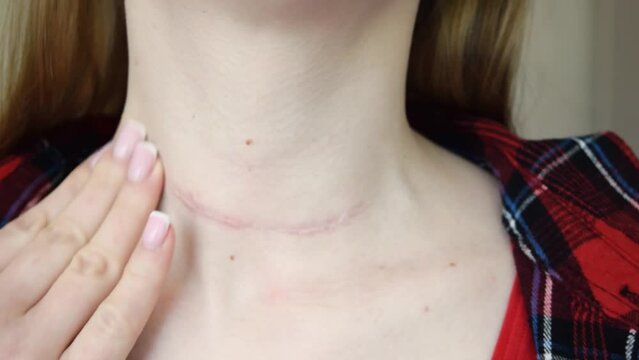 scar after surgery on woman neck