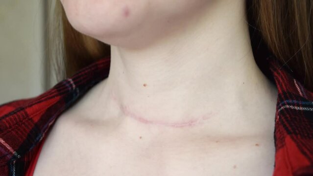 scar after surgery on woman neck