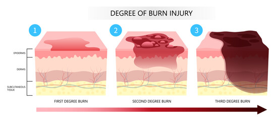 Skin burn injury degree of epidermis tissue layer with flames exposure - obrazy, fototapety, plakaty