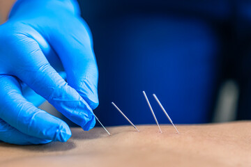 Close up of a needle and hands of physiotherapist doing a dry needling.