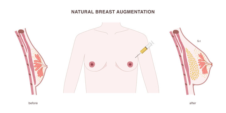Natural breast augmentation with fat transferred into the breast from other body parts. Fat tissue injection illustration with before and after effect.