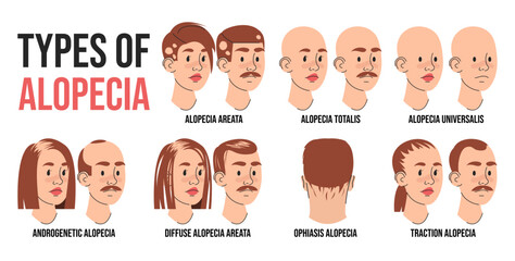 Types of alopecia infographic vector isolated. Illustration of people suffering from hair loss. Alopecia areata, totalis and universalis. Androgenetic and traction alopecia. - obrazy, fototapety, plakaty