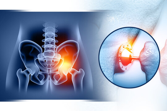 Hip implant, artificial joint. 3d illustration