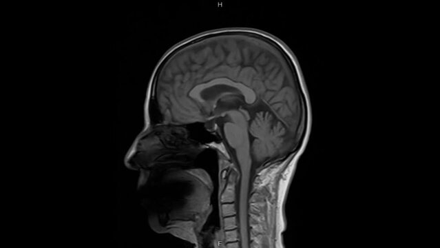 Magnetic resonance imaging of the brain. MRI of the brain. Medical examination of the human brain