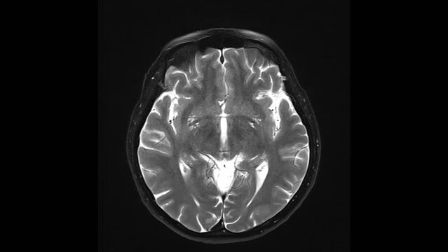 Magnetic resonance imaging of the brain. MRI of the brain. Medical examination of the human brain