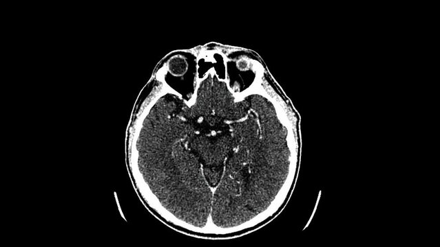 Magnetic resonance imaging of the brain. MRI of the brain. Medical examination of the human brain