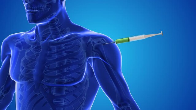 Injecting stem cells into a human shoulder